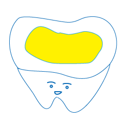 虫歯の図２