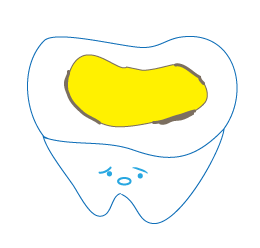 虫歯の図３